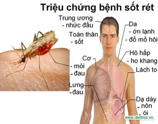 Sốt rét căn bệnh do muỗi gây ra mà người lớn hoặc trẻ em đều dễ mắc phải.